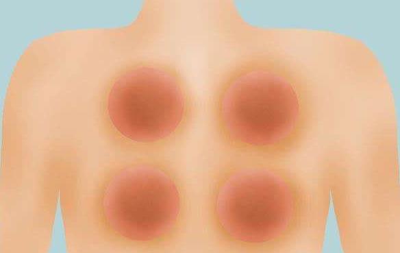 推背全是紫的是濕氣太重嗎