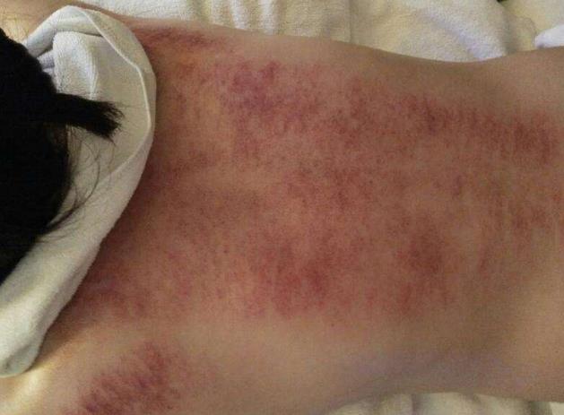 三、背部按摩注意事項