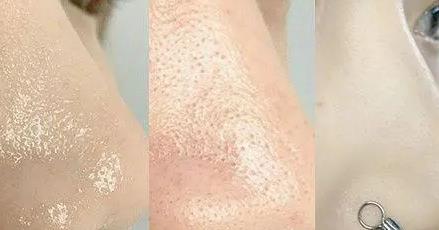 美容院去黑頭話術(shù)，美容院去黑頭方法有哪些