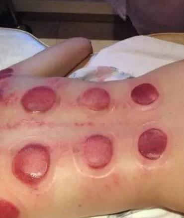 拔罐之后不同的人群呈現(xiàn)出的顏色 拔罐之后不同的人群呈現(xiàn)出的顏色