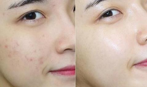 美容院祛斑多少錢，方法